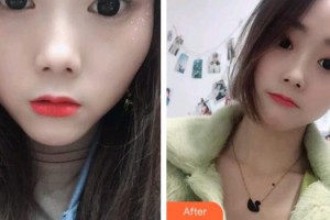 貴陽愛爾眼科醫(yī)院陳曉鐘整形價(jià)格表附切開雙眼皮案例展示