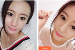 貴陽愛爾眼科醫(yī)院劉誠整形價格表附眼部修復案例展示