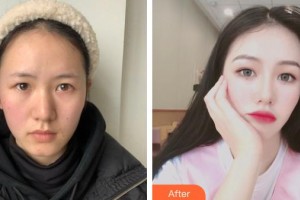 貴陽愛爾眼科醫(yī)院孫儀亞整形價(jià)格表附眼部綜合案例展示