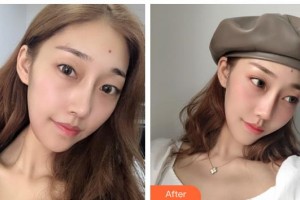 貴陽愛爾眼科醫(yī)院胡大立整形價(jià)格表附眼部綜合案例展示