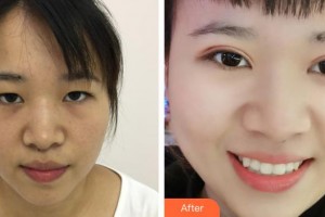 貴陽愛爾眼科醫(yī)院陳國榮整形價(jià)格表附定點(diǎn)雙眼皮案例展示