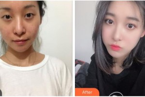 貴陽愛爾眼科醫(yī)院廖進(jìn)軍整形價(jià)格表附切開雙眼皮案例展示