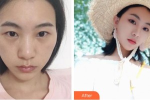 貴陽愛爾眼科醫(yī)院鐘燕整形價(jià)格表附眼部綜合案例展示