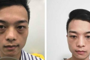 貴陽愛爾眼科醫(yī)院黃加兵整形價(jià)格表附激光去眼袋案例展示