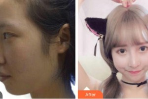 貴陽愛爾眼科醫(yī)院陳筑惠整形價格表附切開雙眼皮案例展示