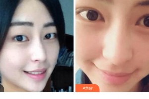 貴陽愛爾眼科醫(yī)院陳曉玲整形價(jià)格表附切開雙眼皮案例展示