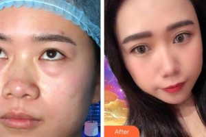 貴陽愛爾眼科醫(yī)院王文放整形價(jià)格表附內(nèi)切祛眼袋案例展示