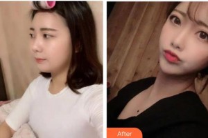 貴陽愛爾眼科醫(yī)院楊潔整形價(jià)格表附切開雙眼皮案例展示