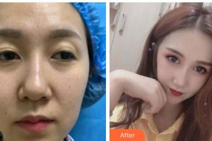 六盤水麗人醫(yī)院醫(yī)療美容科劉曉君整形價(jià)格表附眼部綜合案例展示