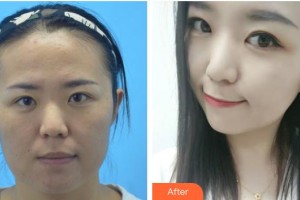 遵義利美康整形美容醫(yī)院吳琳紋繡中心主任整形價(jià)格表附激光祛斑案例展示