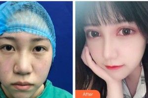 遵義韓美整形美容醫(yī)院彭楠整形價(jià)格表附切開雙眼皮案例展示