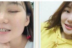 遵義利美康整形美容醫(yī)院劉福榮整形價(jià)格表附牙齒隱形矯正案例展示