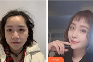 遵義紅美整形美容醫(yī)院曾斌整形價(jià)格表附埋線提升案例展示