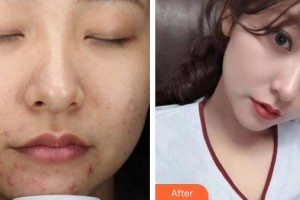 遵義紅美整形美容醫(yī)院詹昌貴整形價(jià)格表附牙齒隱形矯正案例展示