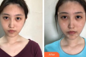 遵義喬雅菲醫(yī)療美容門診部賴炳文整形價(jià)格表附埋線提升案例展示