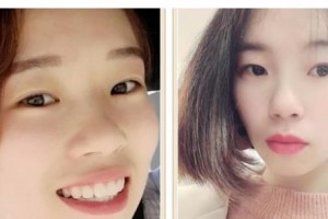 遵義韓美整形美容醫(yī)院李志強(qiáng)整形價(jià)格表附牙齒陶瓷矯正案例展示