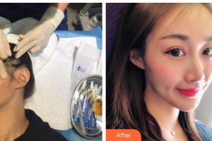 遵義利美康整形美容醫(yī)院龍萍整形價(jià)格表附埋線提升案例展示