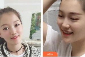 遵義利美康整形美容醫(yī)院曹金喜整形價(jià)格表附金屬托槽矯正案例展示