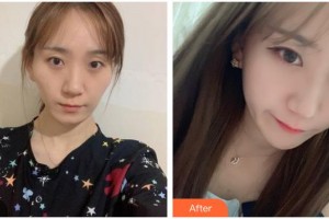 遵義韓美整形美容醫(yī)院吳勝鎮(zhèn)整形價(jià)格表附顴骨顴弓整形術(shù)案例展示