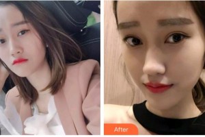 遵義利美康整形美容醫(yī)院武劍整形價(jià)格表附冷光美白案例展示