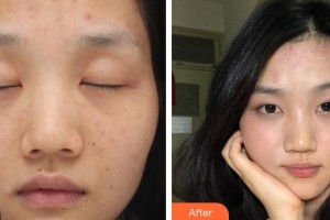 遵義韓美整形美容醫(yī)院于建濤整形價格表附激光祛斑案例展示