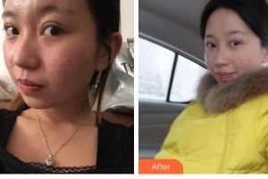 遵義韓美整形美容醫(yī)院楊艷艷整形價格表附光子嫩膚案例展示