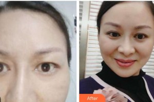 銅仁白領(lǐng)醫(yī)療美容門診部錢炳燊整形價(jià)格表附埋線雙眼皮案例展示