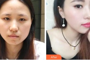 銅仁仁愛眼科醫(yī)院蔣海贇整形價(jià)格表附切開雙眼皮案例展示