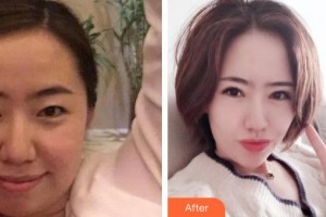 銅仁仁愛眼科醫(yī)院劉承整形價(jià)格表附眼部綜合案例展示