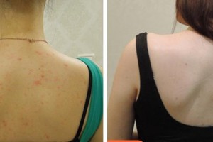 畢節(jié)利美康醫(yī)療美容門診部劉冰語(yǔ)整形價(jià)格表附清潔祛痘案例展示