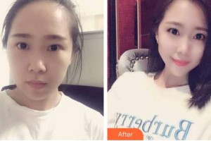 畢節(jié)西南皮膚病醫(yī)院郭惠中整形價(jià)格表附切開雙眼皮案例展示