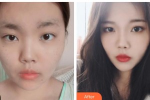 畢節(jié)市第一人民醫(yī)院燒傷整形外科徐佳麗整形價(jià)格表附光子嫩膚案例展示