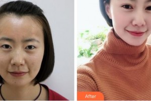 畢節(jié)陽(yáng)明眼科醫(yī)院梁占瑩整形價(jià)格表附切開雙眼皮案例展示