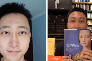 畢節(jié)西南皮膚病醫(yī)院官偉整形價(jià)格表附種植眉毛案例展示