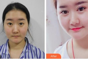 畢節(jié)陽(yáng)明眼科醫(yī)院郝建整形價(jià)格表附眼部綜合案例展示