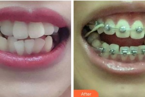 青?？等A整形醫(yī)院時(shí)林月整形價(jià)格表附金屬托槽矯正案例展示