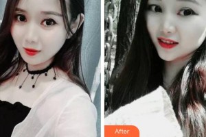 青海省人民醫(yī)院頜面整形外科周泉整形價(jià)格表附牙齒隱形矯正案例展示