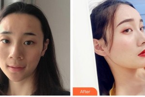 青海米瀾之星整形美容醫(yī)院張光武整形價(jià)格表附鼻部綜合案例展示