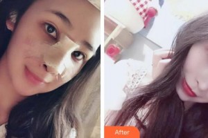 青海康華整形醫(yī)院馬晶整形價(jià)格表附鼻部綜合案例展示