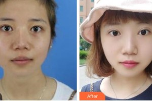 青?？等A整形醫(yī)院宋羽整形價(jià)格表附激光祛斑案例展示