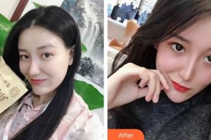 張家港康麗?？漆t(yī)院整形美容外科開學(xué)蘭住院醫(yī)師整形價格表附清潔祛痘案例展示