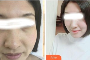 張家港康麗?？漆t(yī)院整形美容外科陸玉萍整形價格表附美白嫩膚案例展示