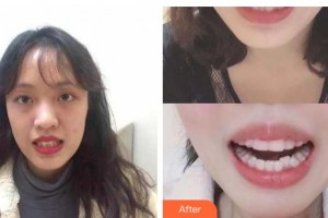 張家港康麗?？漆t(yī)院整形美容外科范立國整形價格表附牙齒隱形矯正案例展示