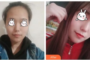 張家港唯恩醫(yī)療美容醫(yī)院蒯成官整形價格表附光子嫩膚案例展示