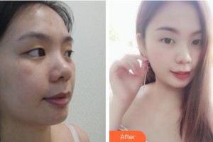 張家港唯恩醫(yī)療美容醫(yī)院陳天杰整形價格表附無針水光案例展示