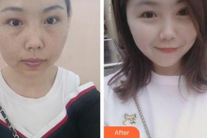 張家港吳寶紅醫(yī)療美容診所吳寶紅整形價格表附激光祛斑案例展示