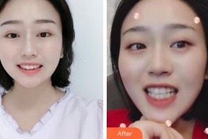 張家港康麗?？漆t(yī)院整形美容外科劉勝整形價格表附牙齒隱形矯正案例展示