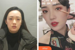 武警廣西總隊醫(yī)院醫(yī)學(xué)整形美容中心趙福德整形價格表附熱瑪吉案例展示