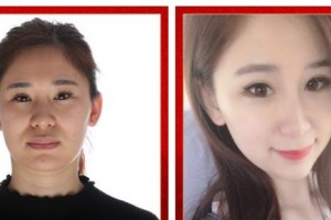 武警廣西總隊(duì)醫(yī)院醫(yī)學(xué)整形美容中心張潮整形價(jià)格表附埋線提升案例展示