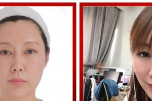 武警廣西總隊(duì)醫(yī)院醫(yī)學(xué)整形美容中心王朝生 教授整形價(jià)格表附埋線提升案例展示